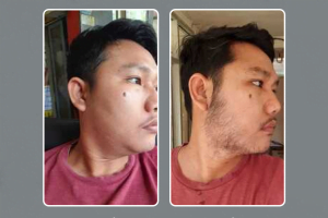 Menumbuhkan Brewok Idaman Tanpa Gen Brewok!