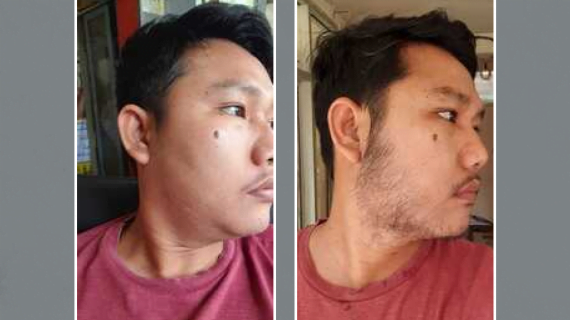 Menumbuhkan Brewok Idaman Tanpa Gen Brewok!