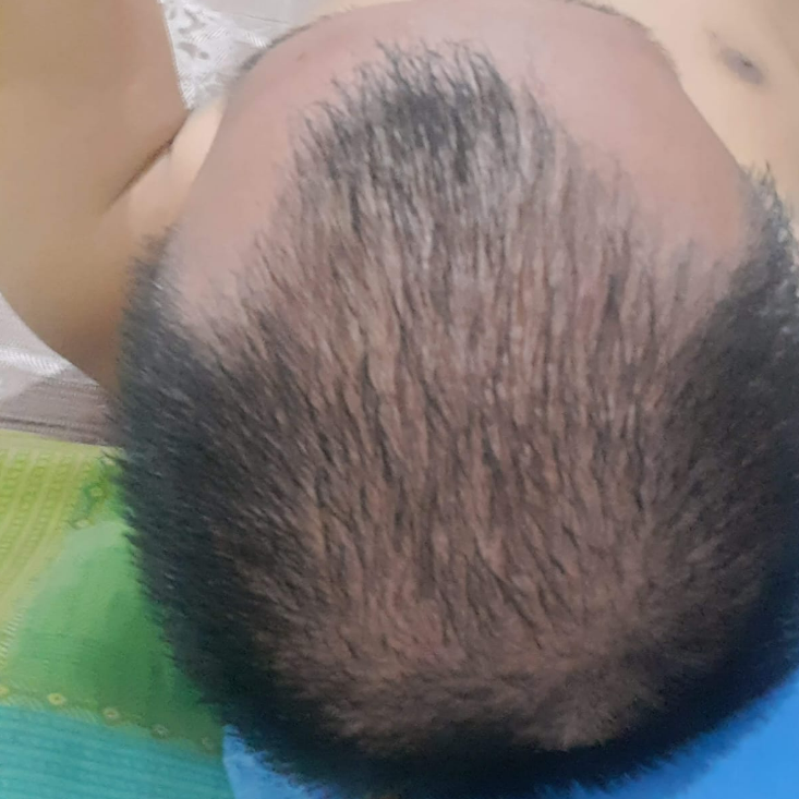 sebelum penggunaan penumbuh rambut fabron
