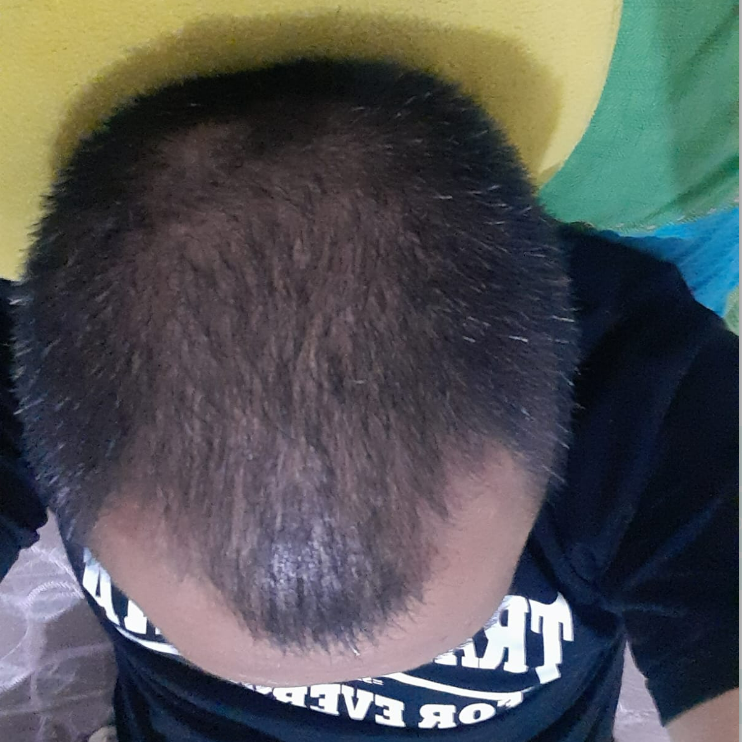 setelah pemakaian penumbuh rambut fabron