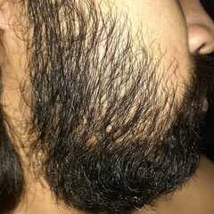 setelah penggunaan penumbuh brewok fabron