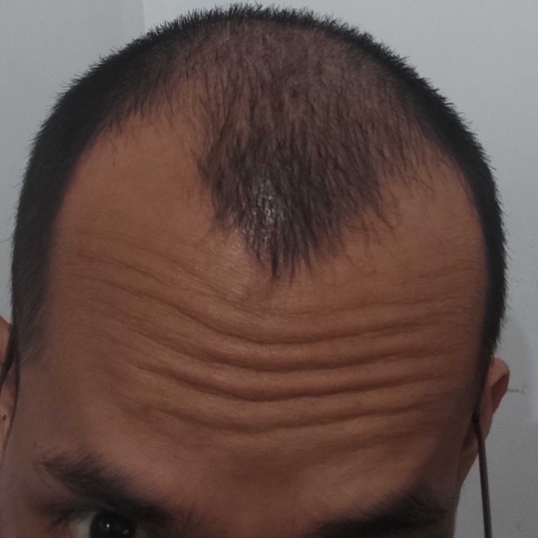 sebelum penggunaan penumbuh rambut fabron