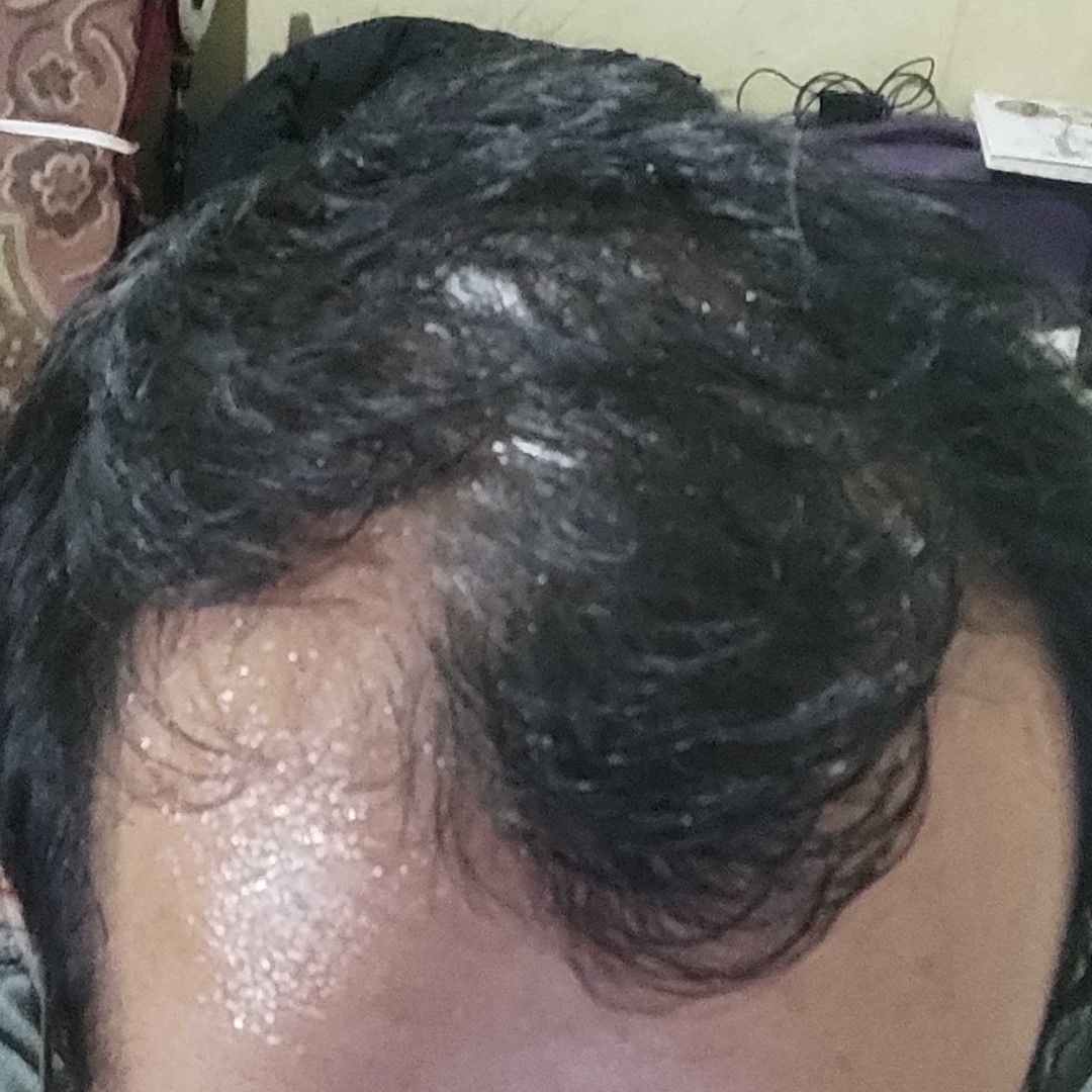 setelah penggunaan penumbuh rambut fabron