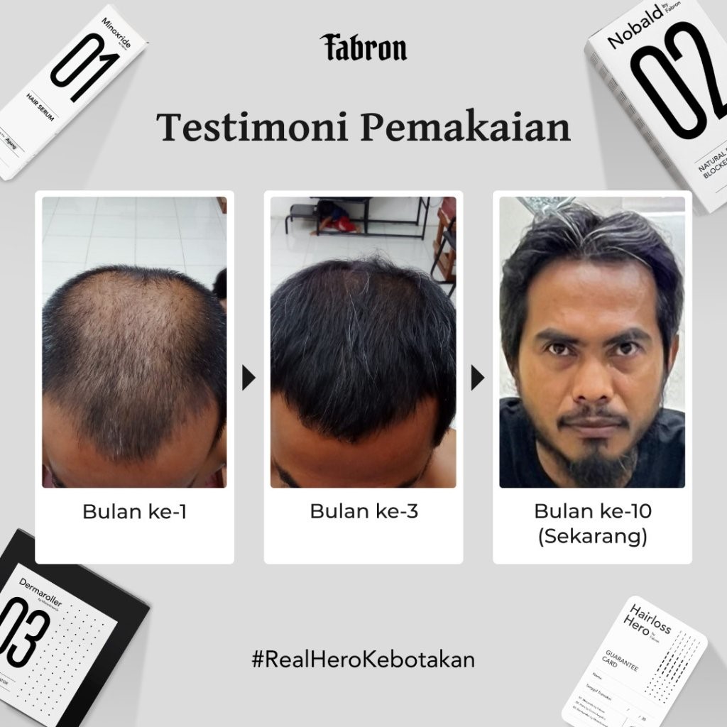 (e-voucher) Hairloss Hero Package - Treatment Kebotakan Pria - Gambar 3