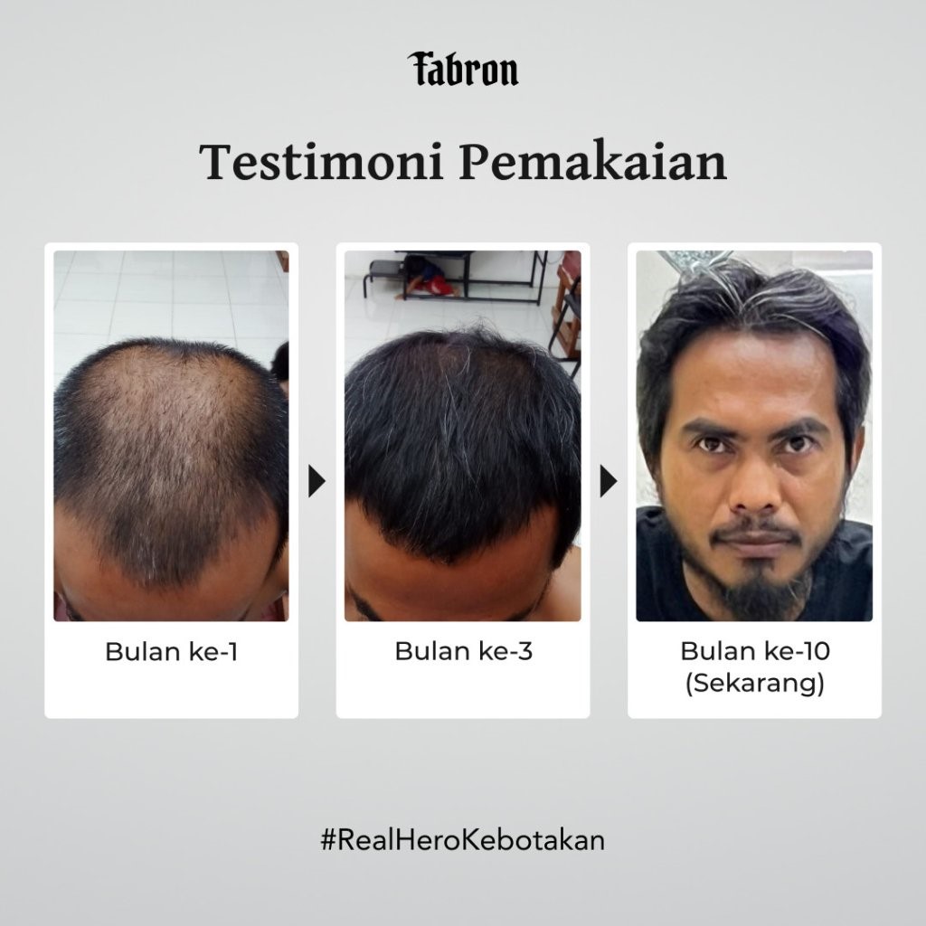 (e-voucher) Minoxride - Hair Starter Treatment - Gambar 5